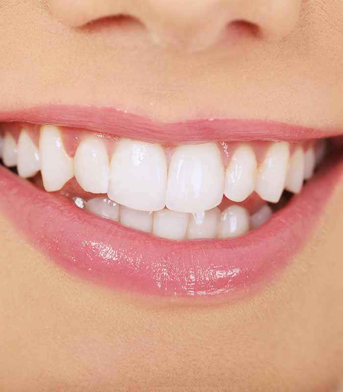 Dental veneers - affordable private dental care near Peterborough